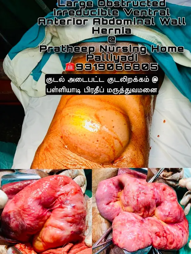 Operative photographs of a large obstructed ventral abdominal wall hernia repair