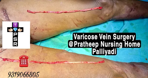 Operative photograph showing veins removed during varicose vein surgery