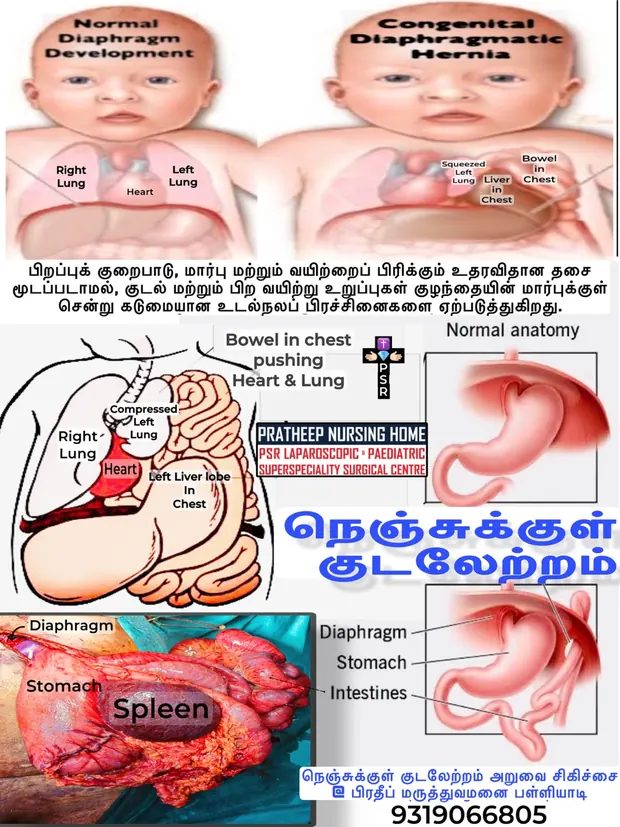 Clinical images relating to congenital diaphragmatic hernia treatment