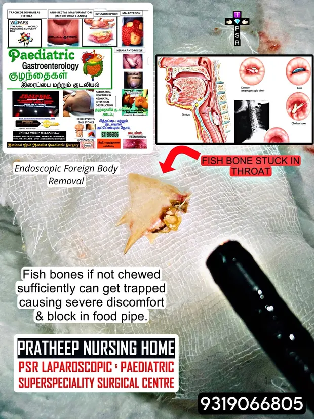 A fish bone removed endoscopically from the food pipe, shown with an explanatory chart