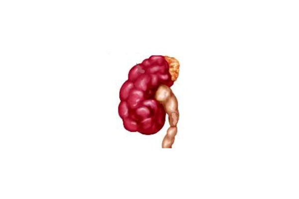 Diagram comparing a normal kidney with a swollen kidney and a distended renal pelvis