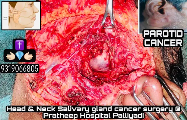 Operative photograph from neck cancer surgery