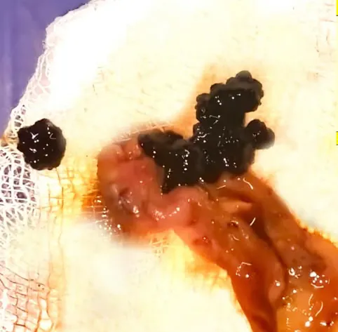 Close-up of a urinary stone removed during a procedure at Pratheep Nursing Home