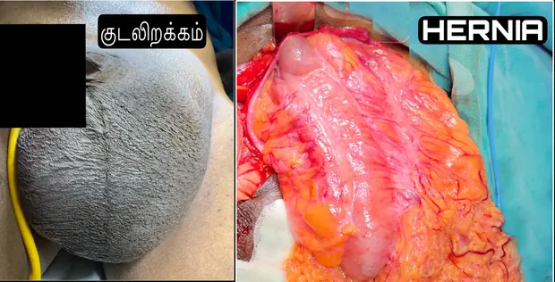 Operative photograph from a hernia repair procedure