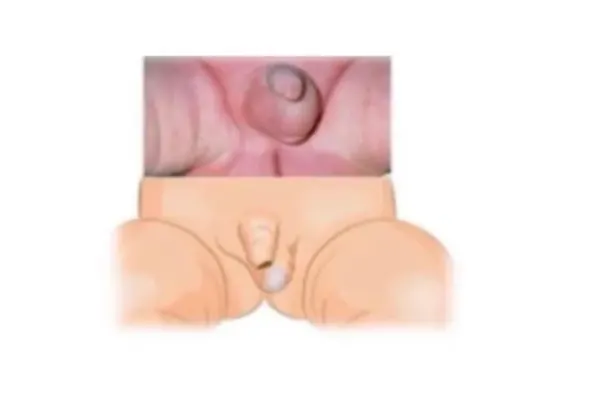 Medical illustration of the scrotum with a testis that has not come down into it